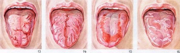 глоссит воспаление языка